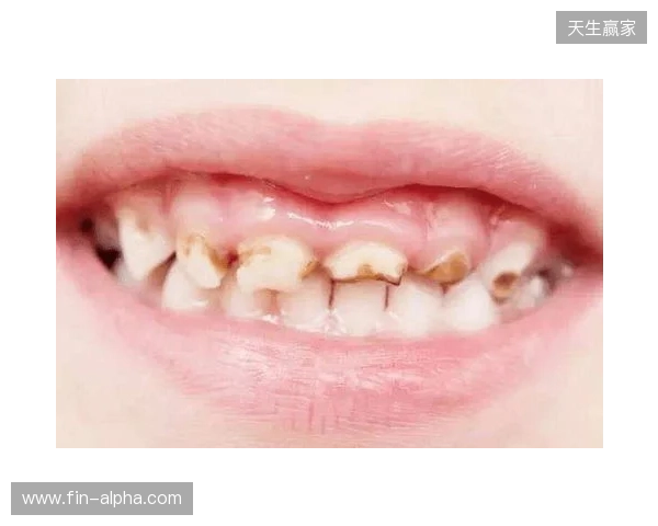 韦林顿确诊上唇部贯通伤;11、21牙半脱位;上颌前牙区牙槽骨骨折 韦林顿确诊上唇部贯通伤;11、21牙半脱位;上颌前牙区牙槽骨骨折